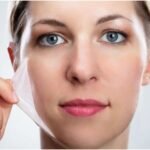 chemical exfoliation for acne prone skin