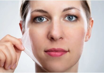 chemical exfoliation for acne prone skin