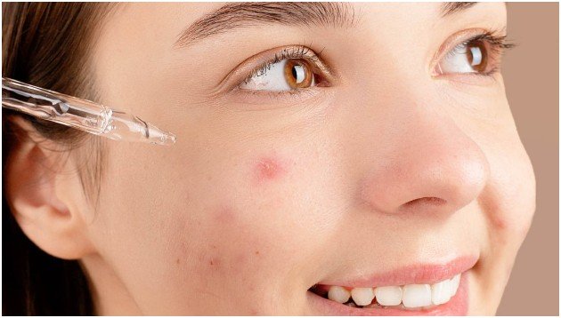 My Simple Routine for Acne-Prone Skin