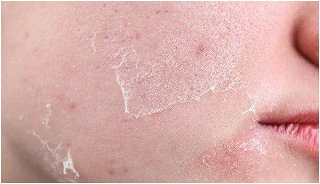 What to Avoid When Using Exfoliating Acids