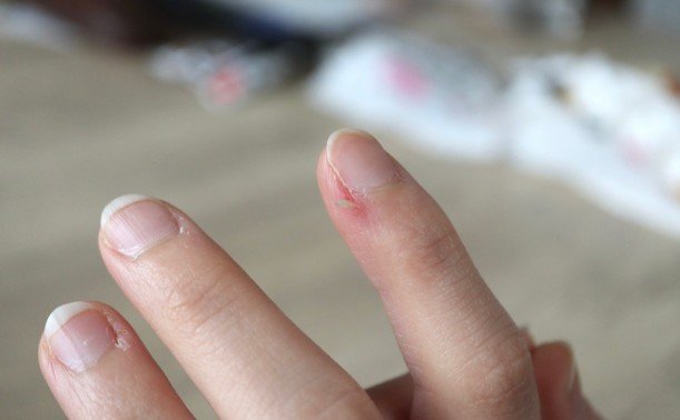 How to Prevent Hangnails From Coming Back - Break the Painful Cycle